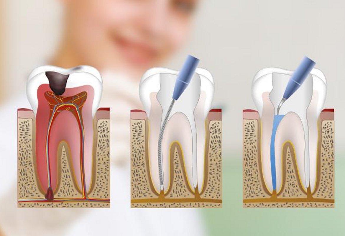 Endodoncias